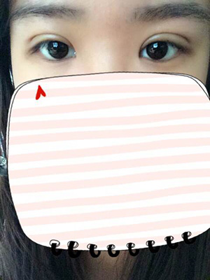 納米x雕雙眼皮15天了~ 我恢復(fù)的算快嗎