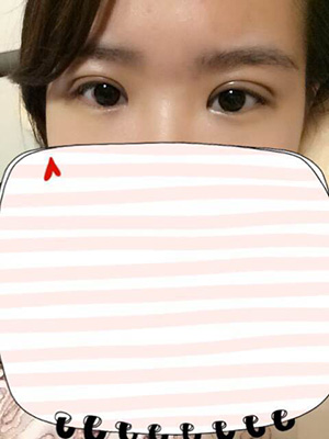 納米x雕雙眼皮15天了~ 我恢復(fù)的算快嗎