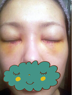 杭州時(shí)光激光去眼袋1個(gè)月了