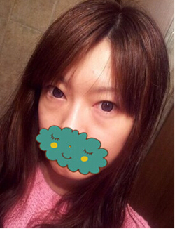 杭州時(shí)光激光去眼袋1個(gè)月了