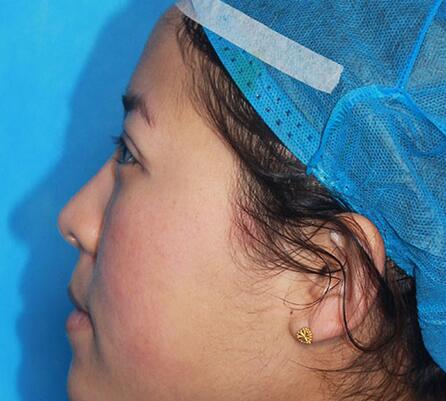 雙眼皮手術(shù)讓我單眼皮變雙眼皮就是這么簡單