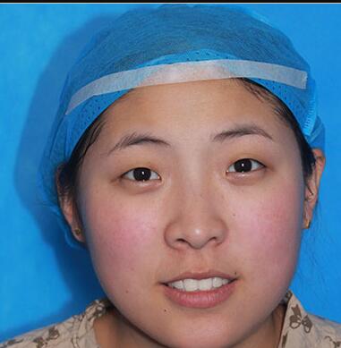 雙眼皮手術(shù)讓我單眼皮變雙眼皮就是這么簡單