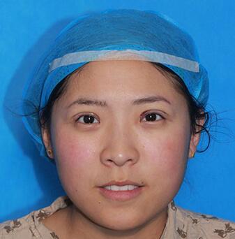 雙眼皮手術(shù)讓我單眼皮變雙眼皮就是這么簡單