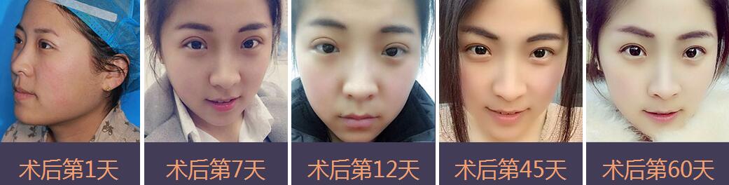 手術(shù)恢復(fù)過程