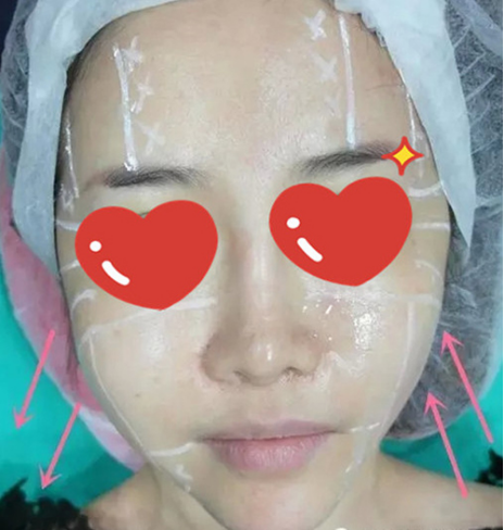 做了拉皮除皺 我的皮膚越來越緊致光滑了
