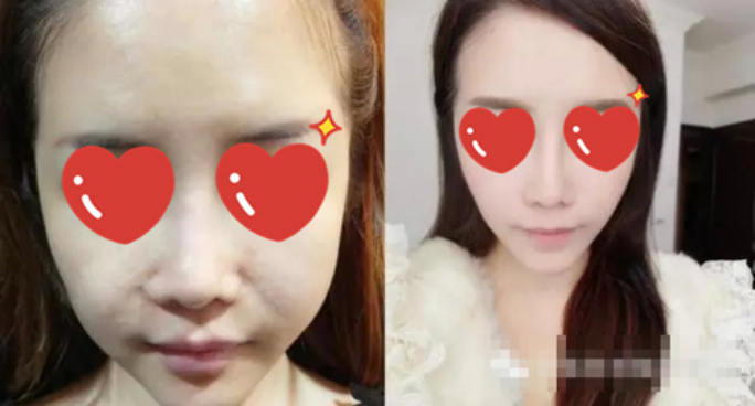 做了拉皮除皺 我的皮膚越來越緊致光滑了