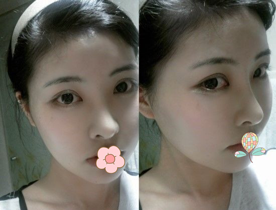 做了磨顴骨手術的我從小鴨子變成白天鵝 謝謝柳大烈教授