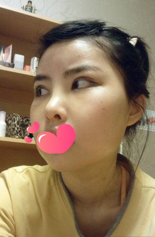 做了磨顴骨手術的我從小鴨子變成白天鵝 謝謝柳大烈教授