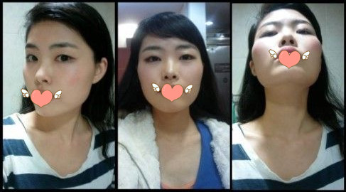 做了磨顴骨手術的我從小鴨子變成白天鵝 謝謝柳大烈教授