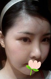 做了磨顴骨手術的我從小鴨子變成白天鵝 謝謝柳大烈教授