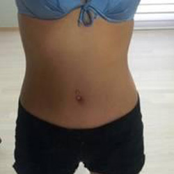 北京清木腰腹吸脂3個月感受