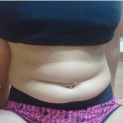 北京清木腰腹吸脂3個月感受