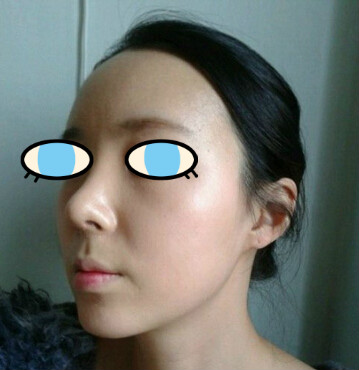 做了膨體隆鼻我也有了高鼻梁 **