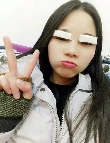 成都蜀尚蓉雅雙眼皮恢復(fù)紀(jì)實(shí) 看看果怎么樣