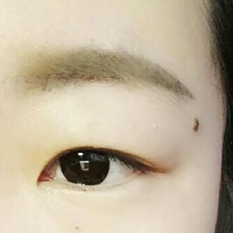雙眼皮恢復(fù)過(guò)程分享
