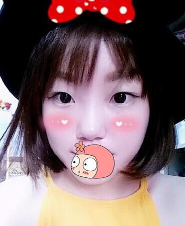 雙眼皮恢復(fù)過(guò)程分享