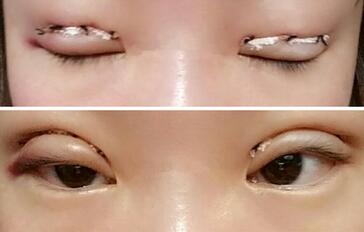 雙眼皮恢復(fù)過(guò)程分享