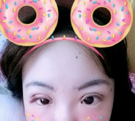 雙眼皮恢復(fù)過(guò)程分享