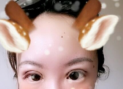 雙眼皮恢復(fù)過(guò)程分享