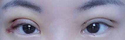 雙眼皮恢復(fù)過(guò)程分享