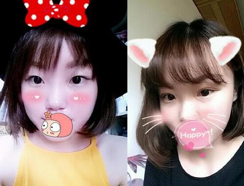 雙眼皮恢復(fù)過(guò)程分享