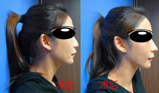 Misko隆鼻讓我鼻子變得挺拔嬌俏無壓力