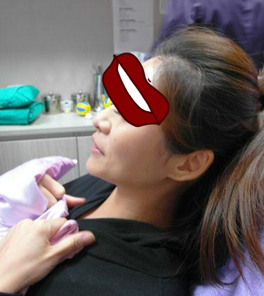 Misko隆鼻讓我鼻子變得挺拔嬌俏無壓力