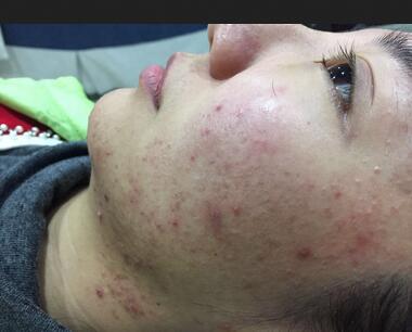 北京歐華去痘坑痘印兩個月