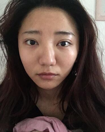 北京歐華去痘坑痘印兩個月