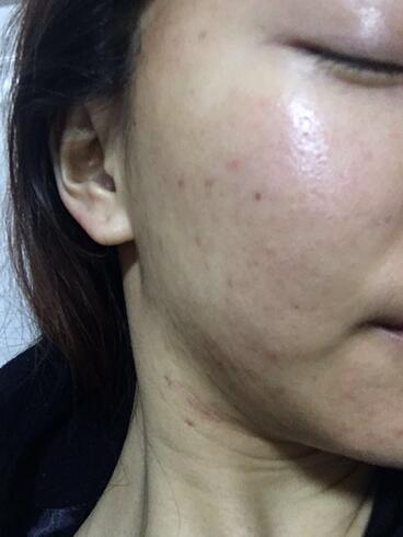 北京歐華去痘坑痘印兩個月