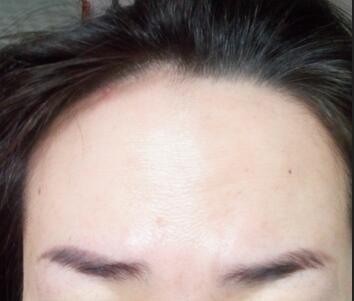 激光祛斑20天后的圖片 北京歐華王芳