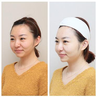 我做射頻緊膚經(jīng)歷 醫(yī)師:北京歐華王芳