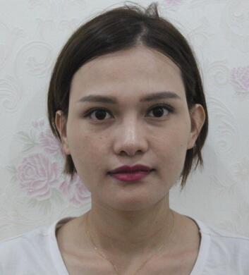 玻尿酸豐太陽7天果圖 愛悅麗格豐太陽穴一個月啦~