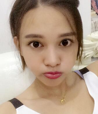 玻尿酸豐太陽7天果圖 愛悅麗格豐太陽穴一個月啦~