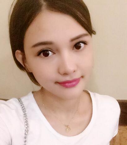 玻尿酸豐太陽7天果圖 愛悅麗格豐太陽穴一個月啦~