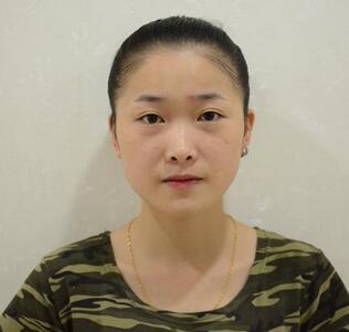 愛悅麗格玻尿酸豐蘋果肌、豐下巴、隆鼻