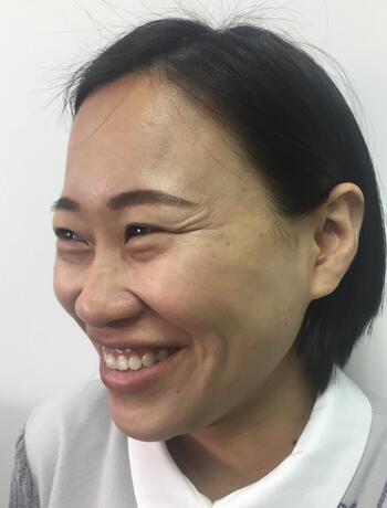 武漢中愛注射瘦臉去魚尾紋一個(gè)月