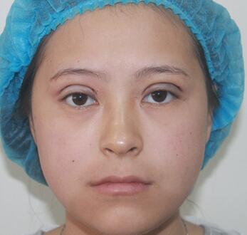 梨花雨割雙眼皮恢復(fù)半年了