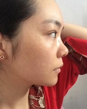 梨花雨隆鼻整形的恢復經(jīng)歷