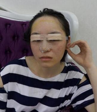 梨花雨隆鼻整形的恢復經(jīng)歷