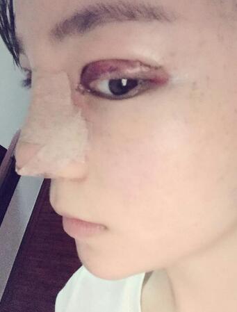 梨花雨隆鼻整形的恢復經(jīng)歷