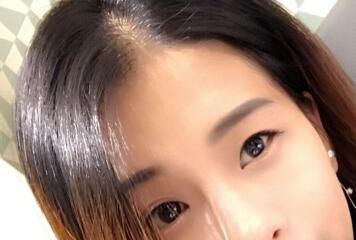 上海韓鏡割雙眼皮一個(gè)月