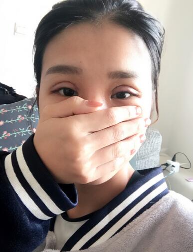 上海韓鏡割雙眼皮一個(gè)月