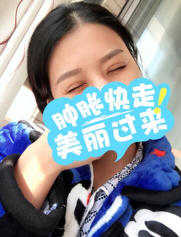 上海韓鏡割雙眼皮一個(gè)月