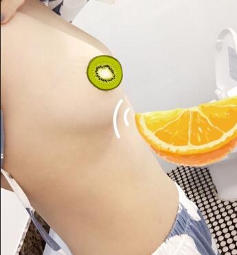 上海韓鏡曼托假體隆胸18天