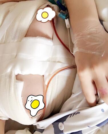 上海韓鏡曼托假體隆胸18天