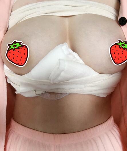 上海韓鏡曼托假體隆胸18天