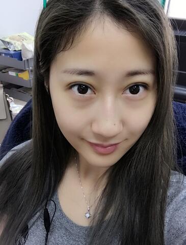 埋線雙眼皮七天恢復(fù)圖