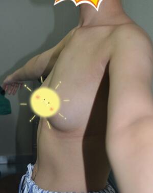 自體脂肪豐胸對比圖 抽脂隆胸十天