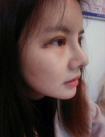 假體隆鼻兩個月后的感覺 隆鼻整形手術(shù)恢復(fù)日記